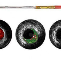 VOLCANO CORP Eagle Eye Platinum Digital IVUS catheter Catheters