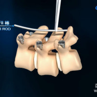 【高清】手术过程演示3D动画制作