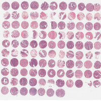 乳腺癌组织芯片BRC2281