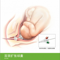 产科一次性使用无菌子宫颈扩张球囊