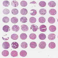 IWLT-N-80B91乳腺癌与癌旁组织芯片