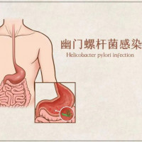 幽门螺杆菌核酸检测及VacA基因分型检测试剂盒（荧光PCR法